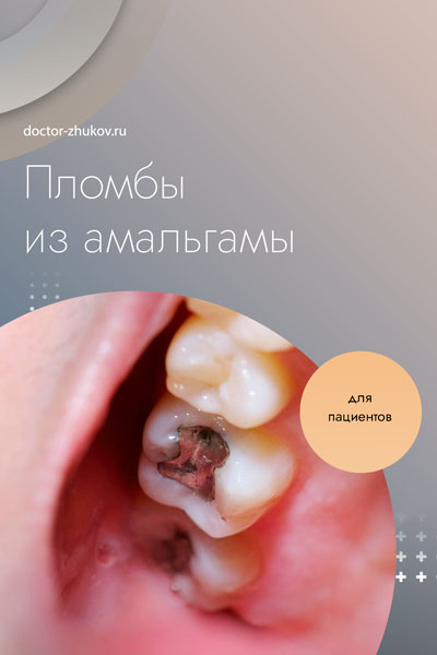 зубные пломбы - амальгама