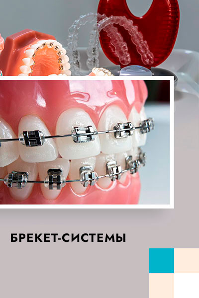 ортодонтия - брекеты