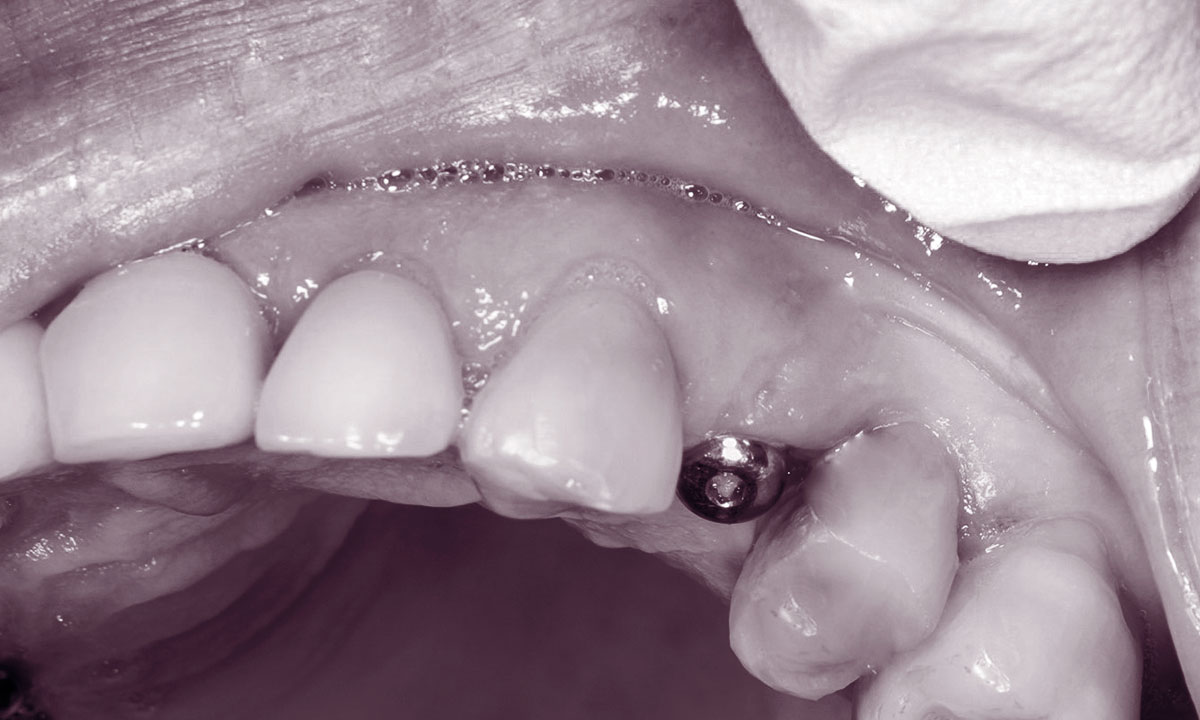 что такое зубной имплант?