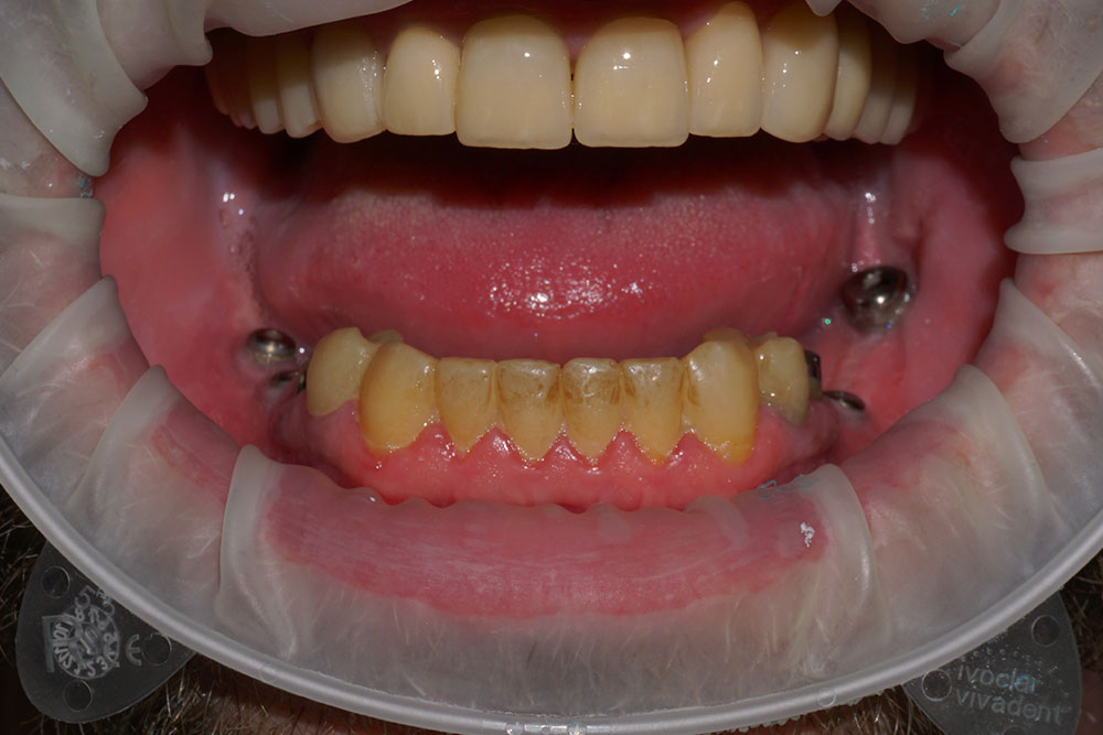 протезирование зубов - до лечения