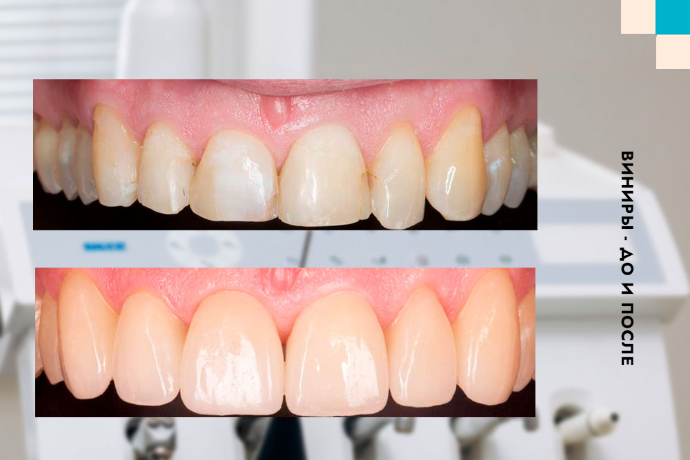 стоматологические виниры - до и после лечения