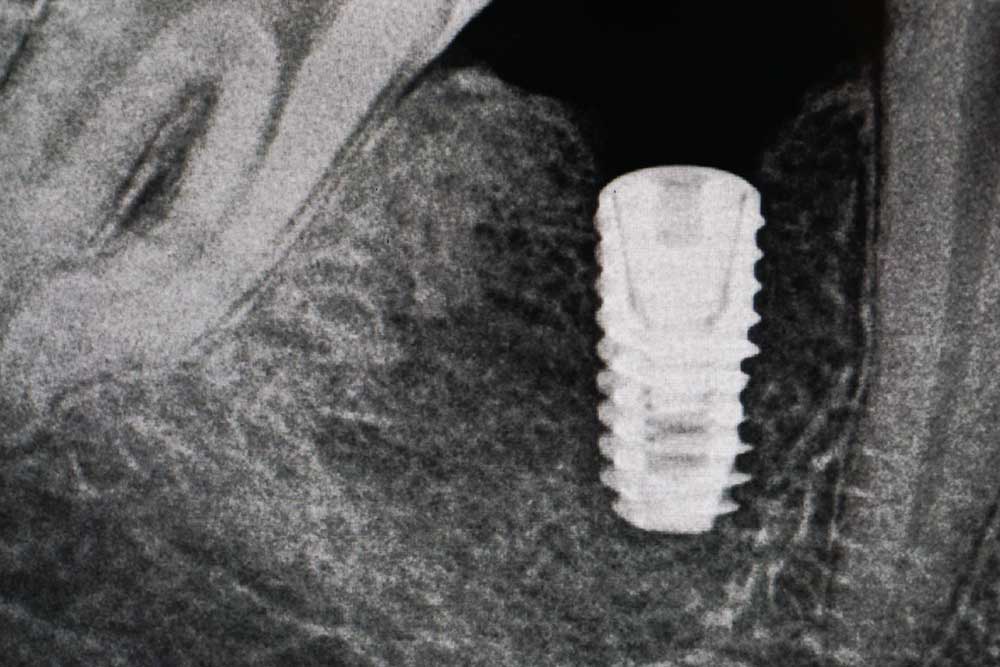 рентгеновский снимок - имплант