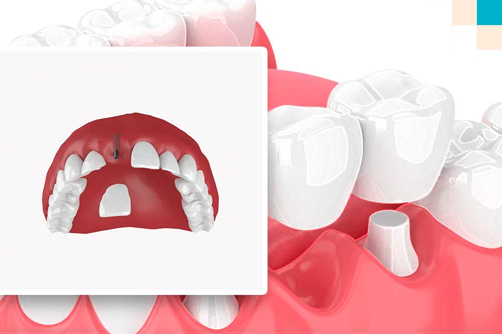 имплант или зубной мост: какой протез лучше?