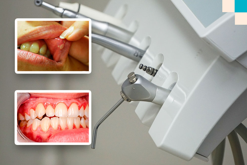 Какие 5 самых распространенных стоматологических заболеваний кроме кариеса
