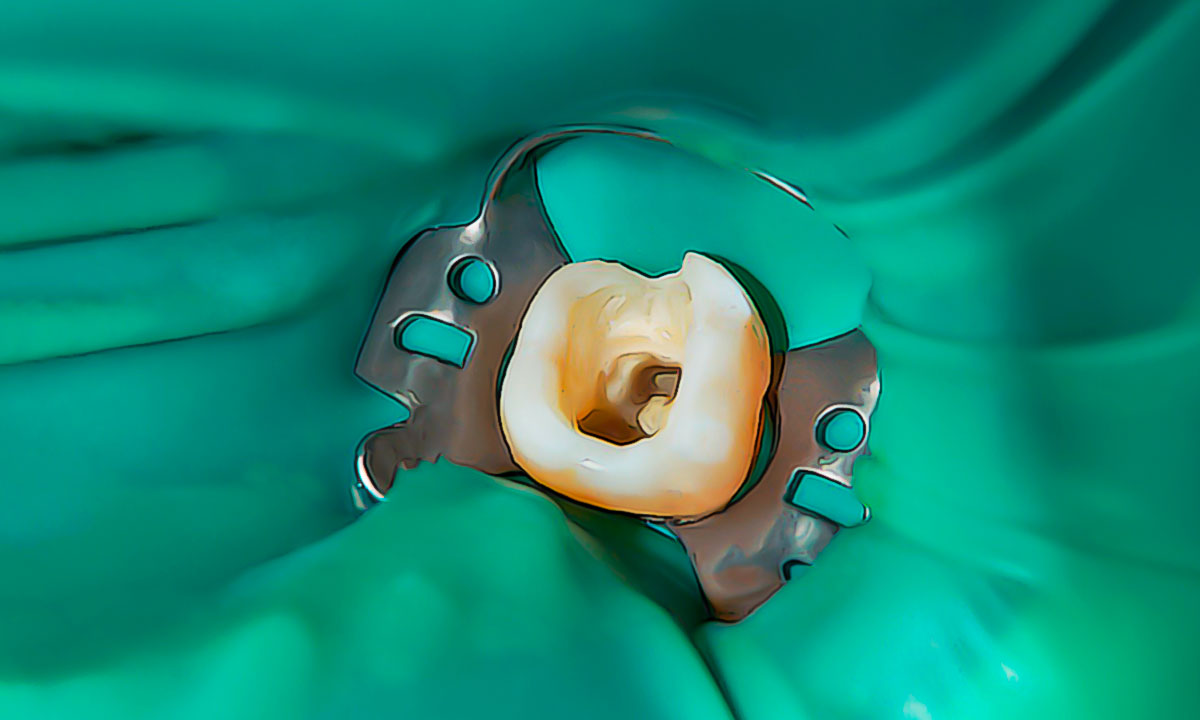 лечение гангренозного пульпита или гангрены зуба