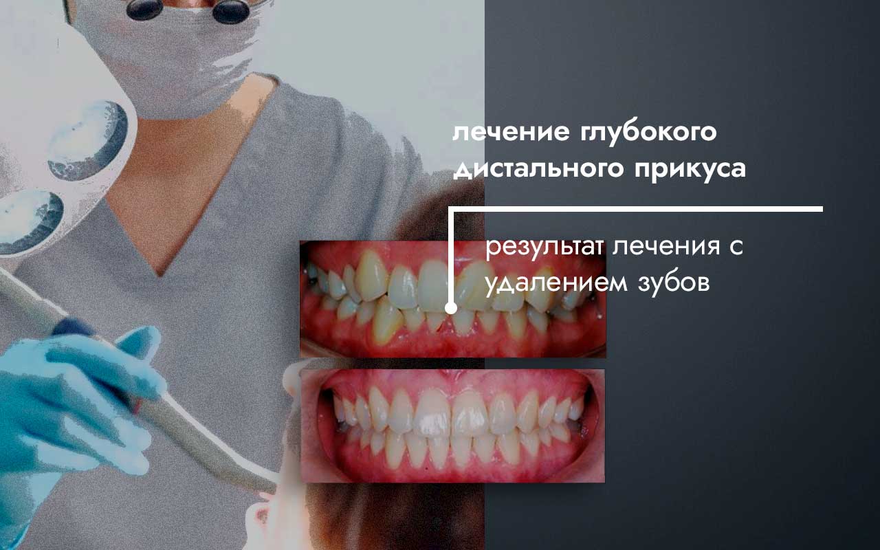 лечение прикуса с удалением зубов