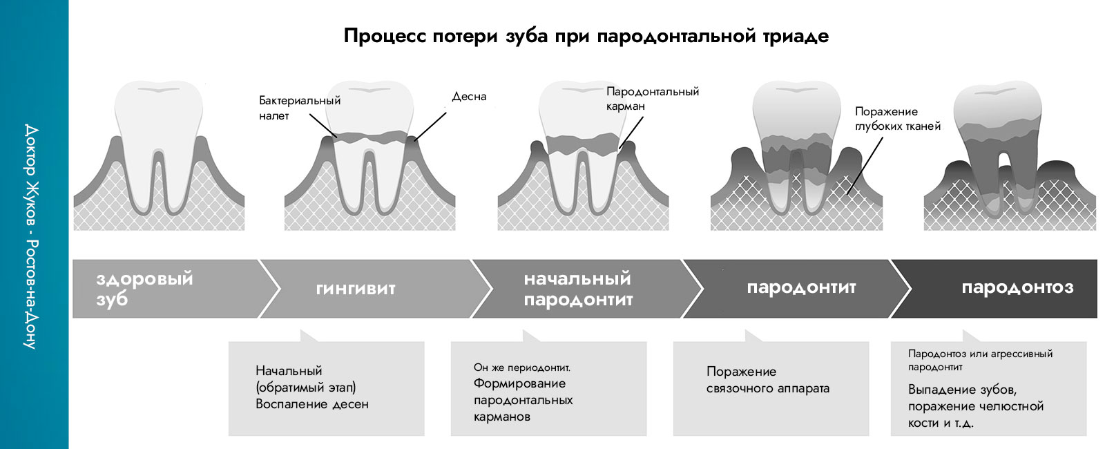 гингивит, пародонтит, пародонтоз - как происходит потеря зуба при пародонтальной триаде