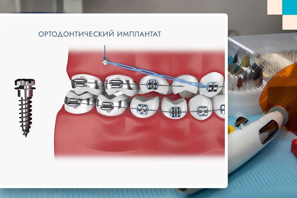 Ортодонтические имплантаты (ВАУ)