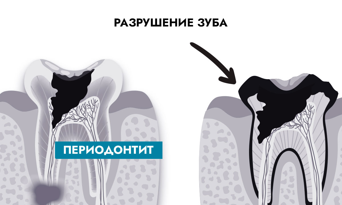 осложнения кариеса - периодонтит, разрушение зуба