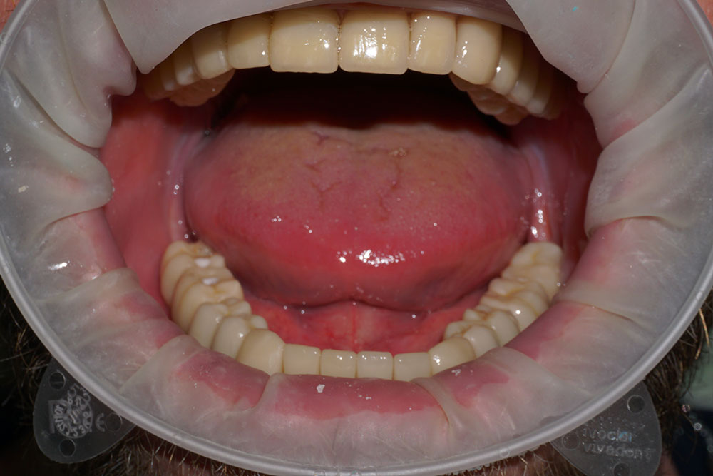 протезирование зубов - после лечения