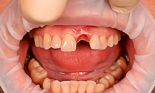 выбор зубного протеза - потеря переднего зуба
