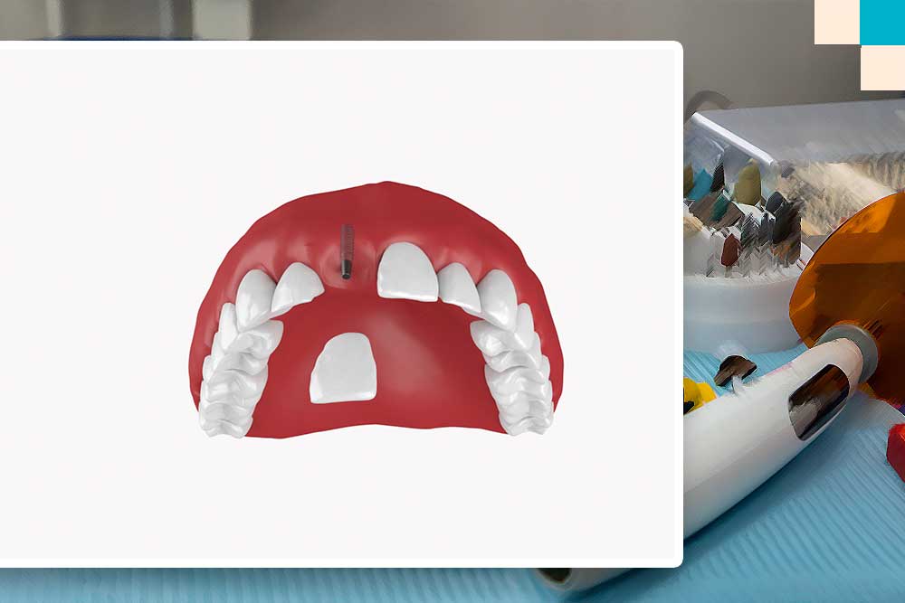 замена одного зуба имплантом