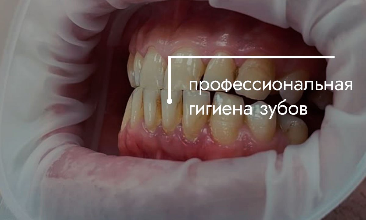 профессиональная гигиена зубов