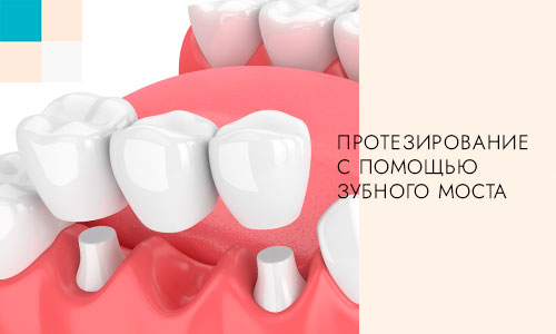протезирование с помощью зубного моста