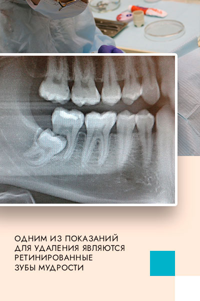 удаление - экстракция зуба