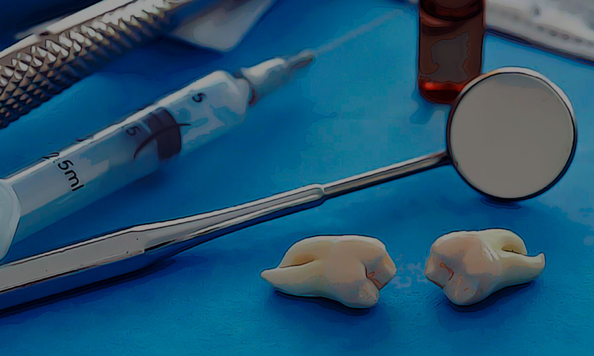 Удаление зуба. Как их избежать осложнений?