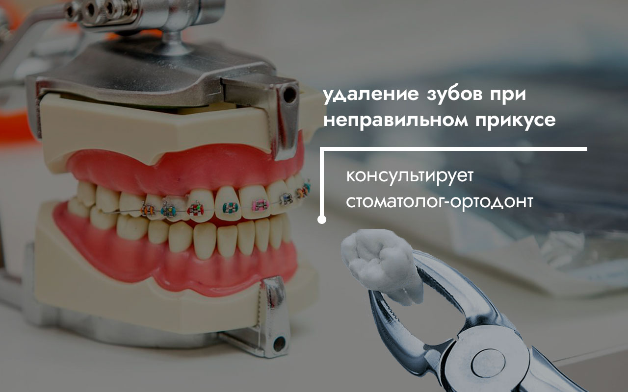 Нужно ли удалять зубы при неправильном прикусе? Мнение специалиста.