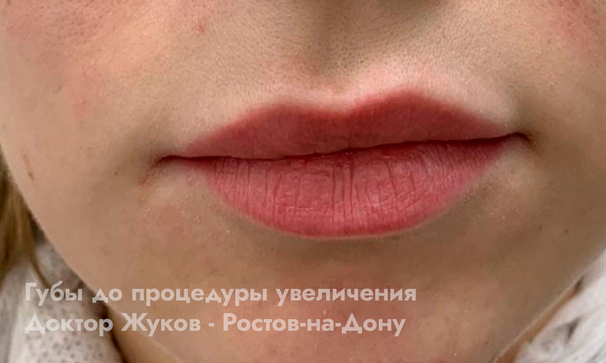фото до процедуры увеличения губ
