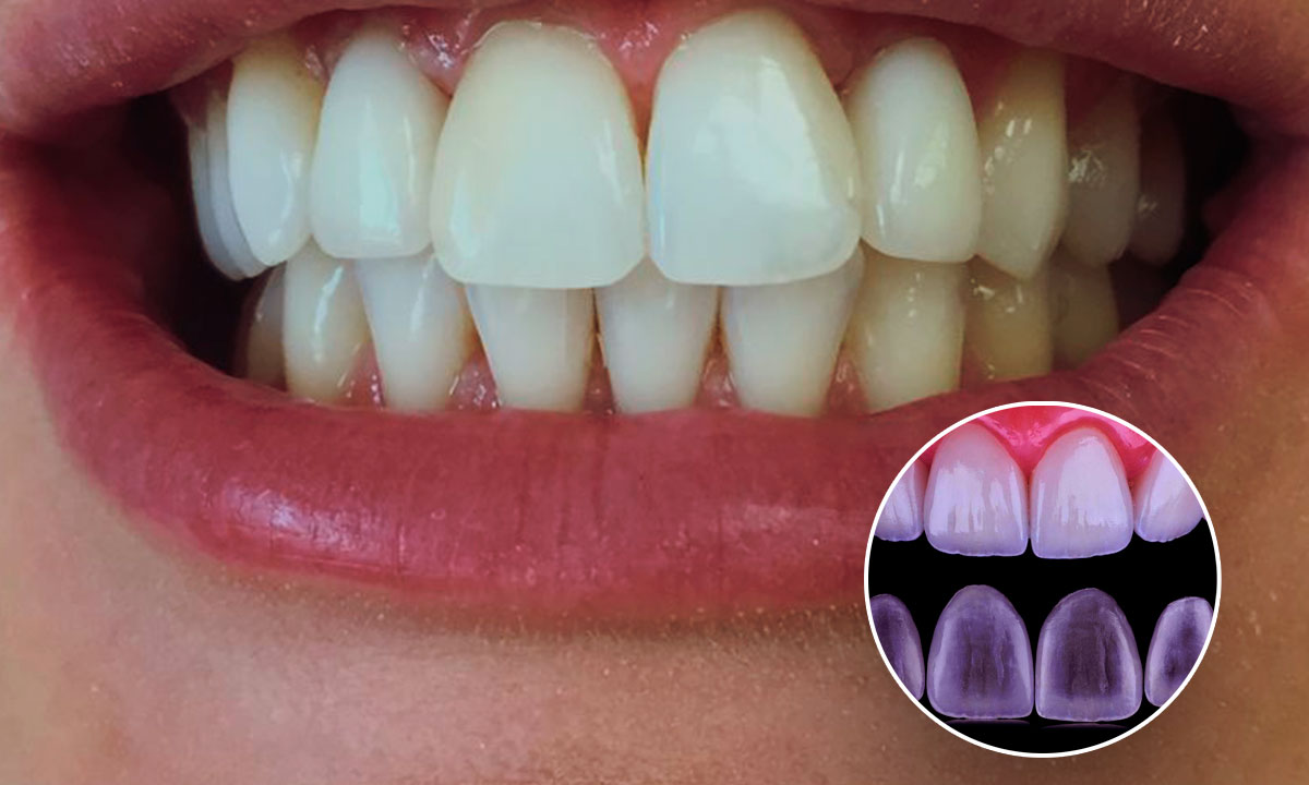 виниры в стоматологии - красивые зубы без протезирования