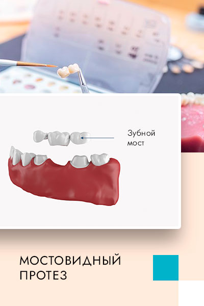 зубной мост или мостовидный протез